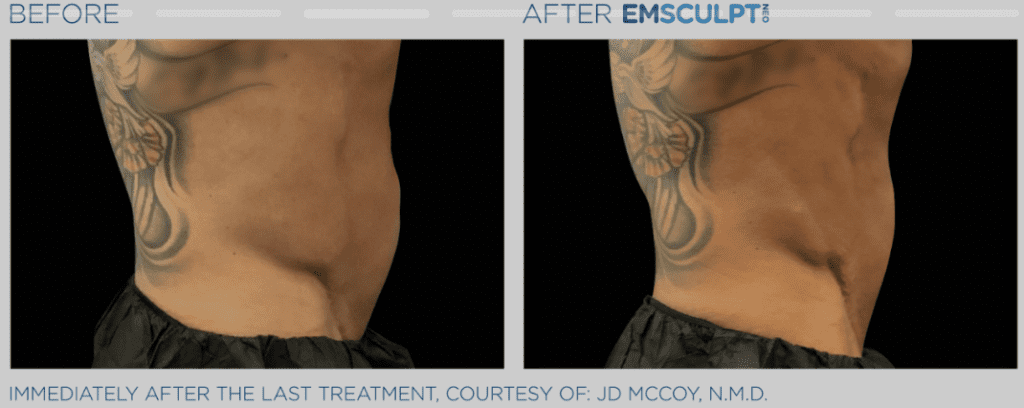 Emsculpting before & after #3